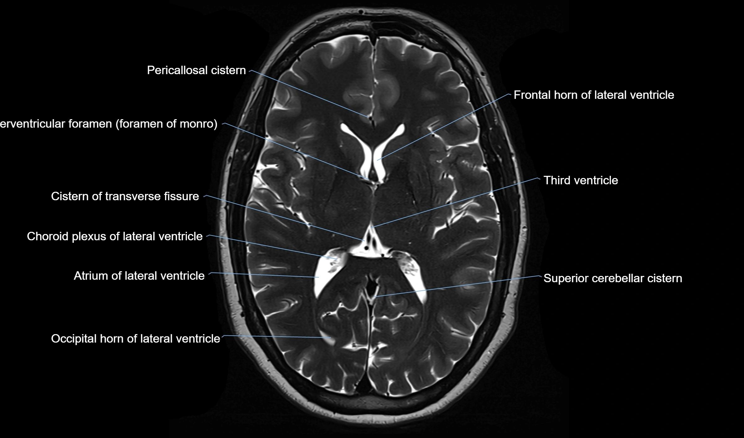 Brain cisterns  and ventricles  axial anatomy 3T MRI image-img-00001-00030.webp